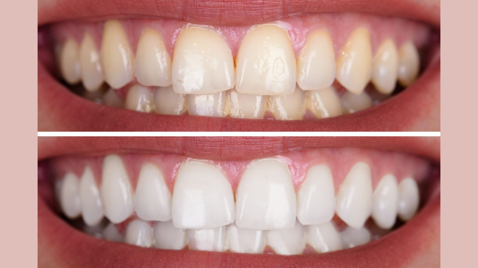 Teeth Whitening